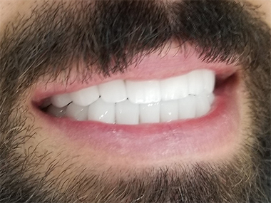 smile makeover in Turkey