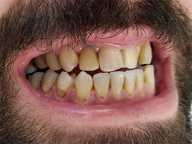 smile makeover in Turkey